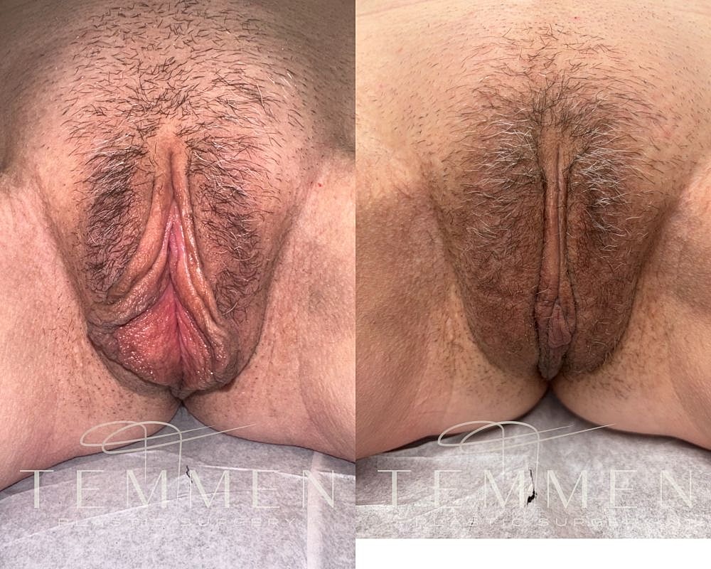 Labiaplasty Before & After