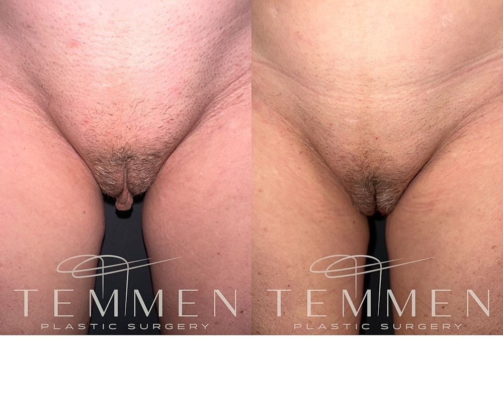 Labiaplasty Before & After
