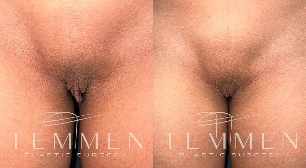 Labiaplasty Before & After