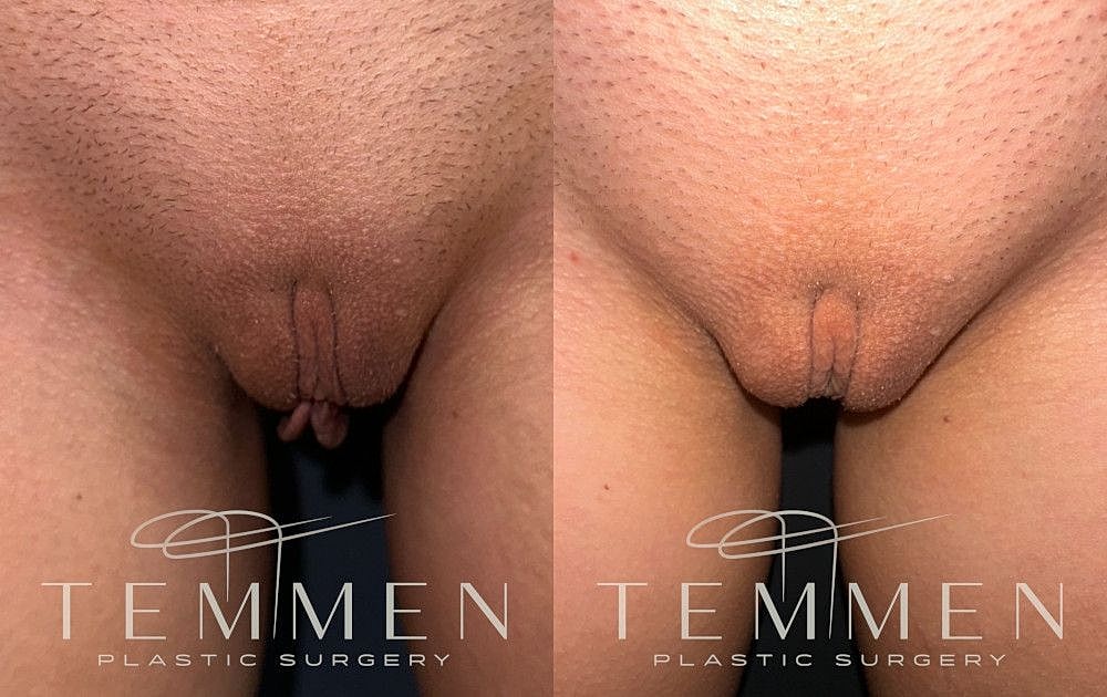 Labiaplasty Before & After