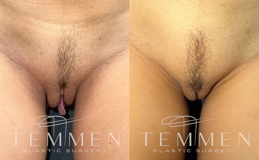 Labiaplasty Before & After