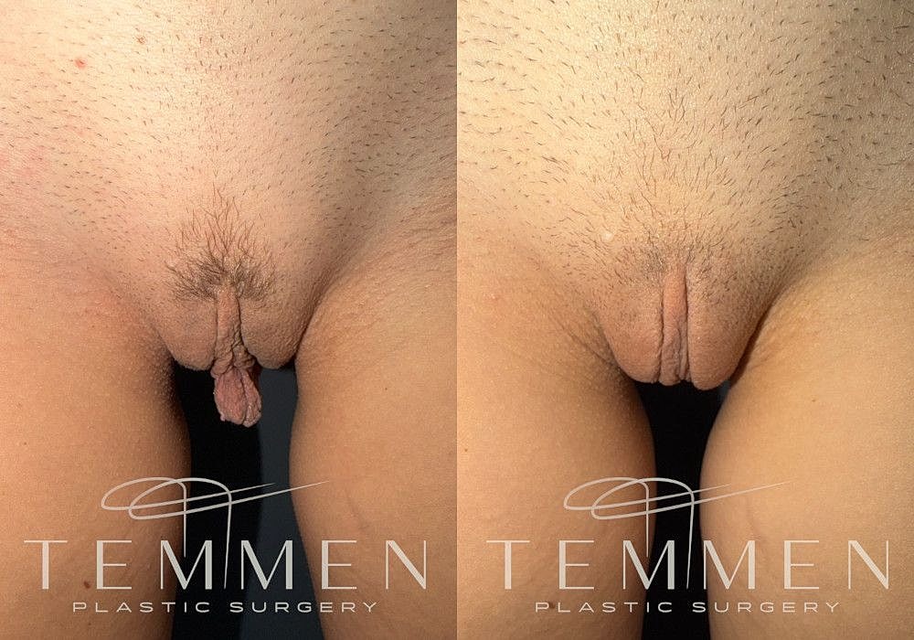 Labiaplasty Before & After