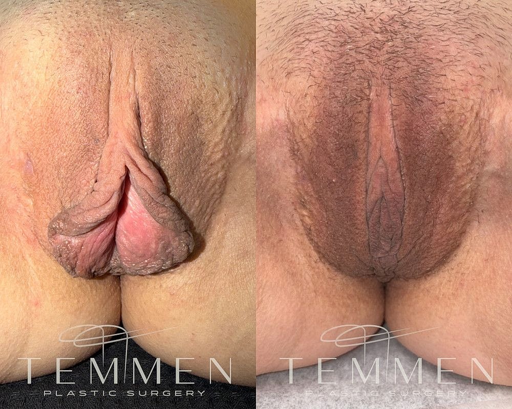 Labiaplasty Before & After