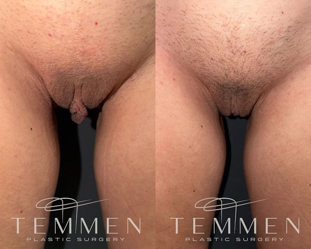 Labiaplasty Before & After