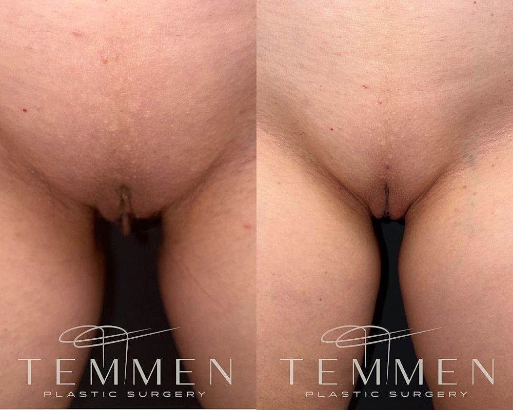 Labiaplasty Before & After
