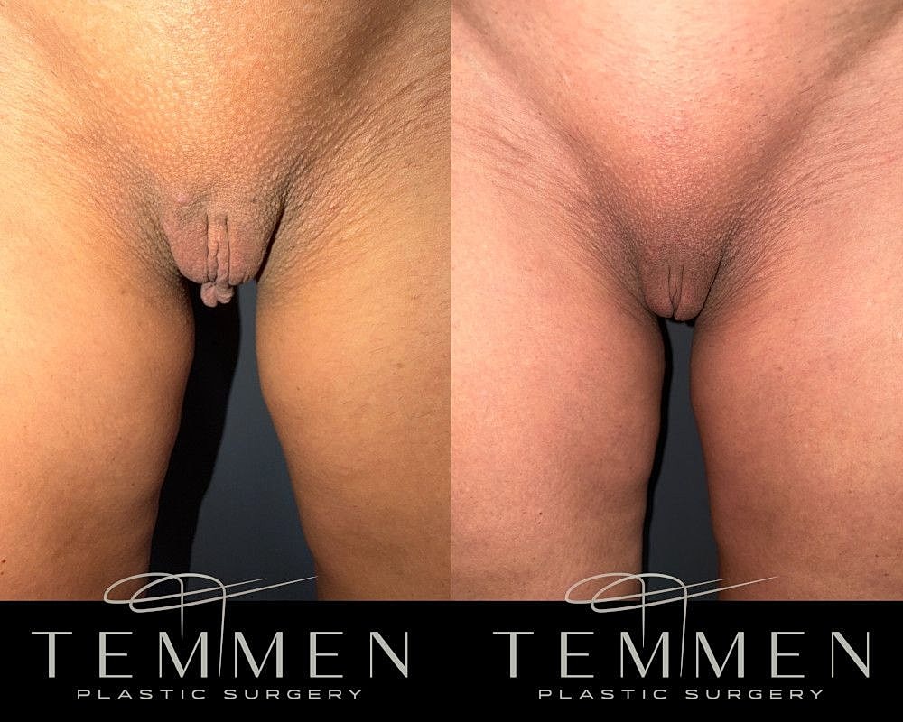 Labiaplasty Before & After