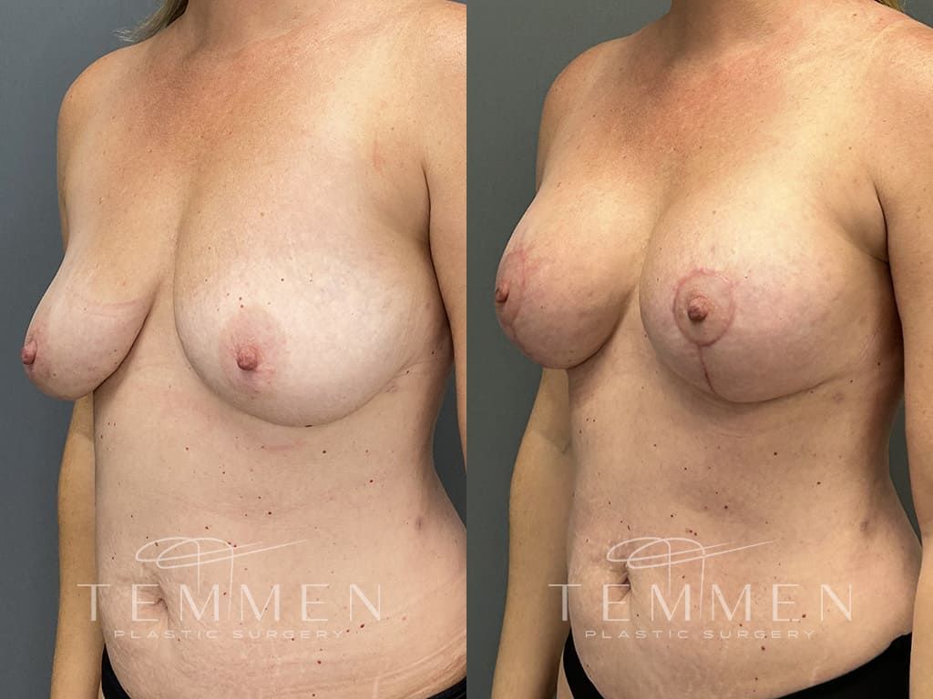 Breast Augmentation With Lift Before & After