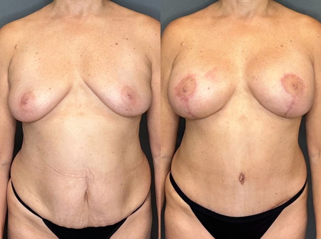 Breast Augmentation With Lift Before & After