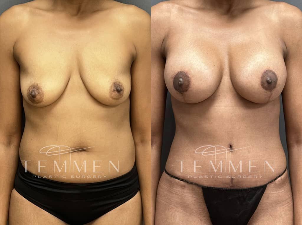 Breast Augmentation With Lift Before & After