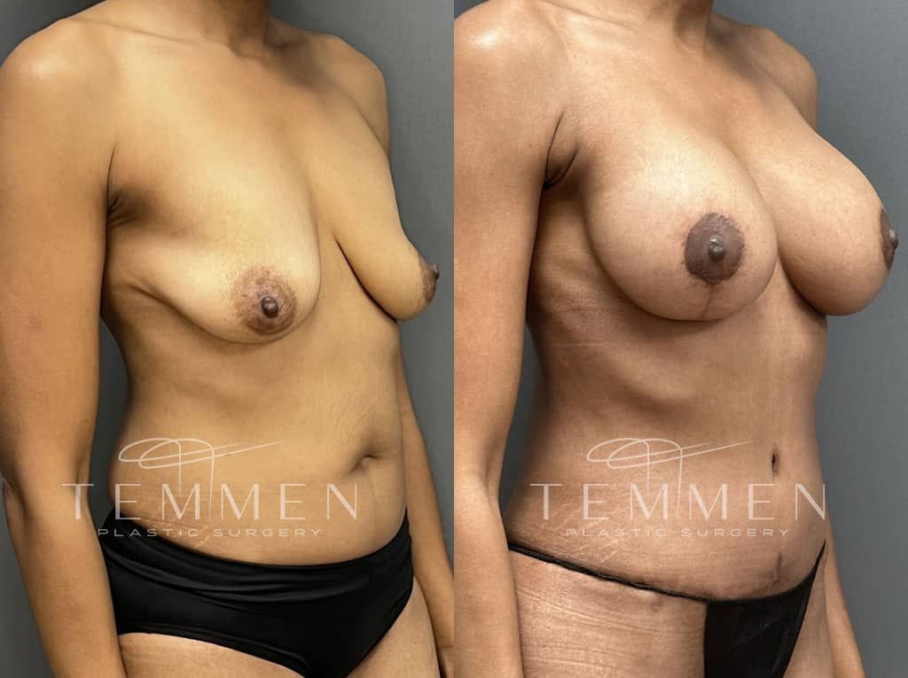 Breast Augmentation With Lift Before & After