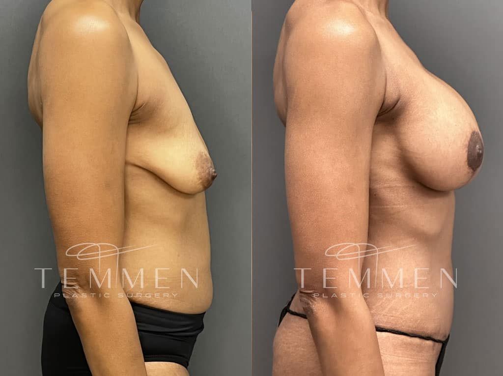 Breast Augmentation With Lift Before & After