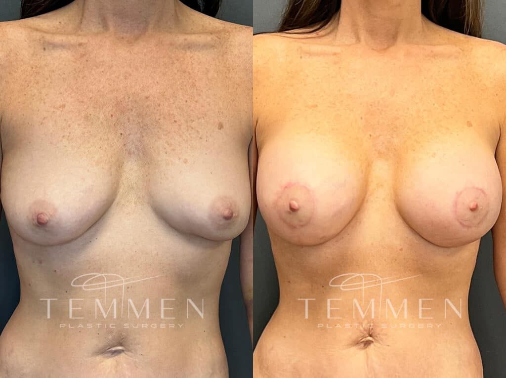 Breast Augmentation With Lift Before & After