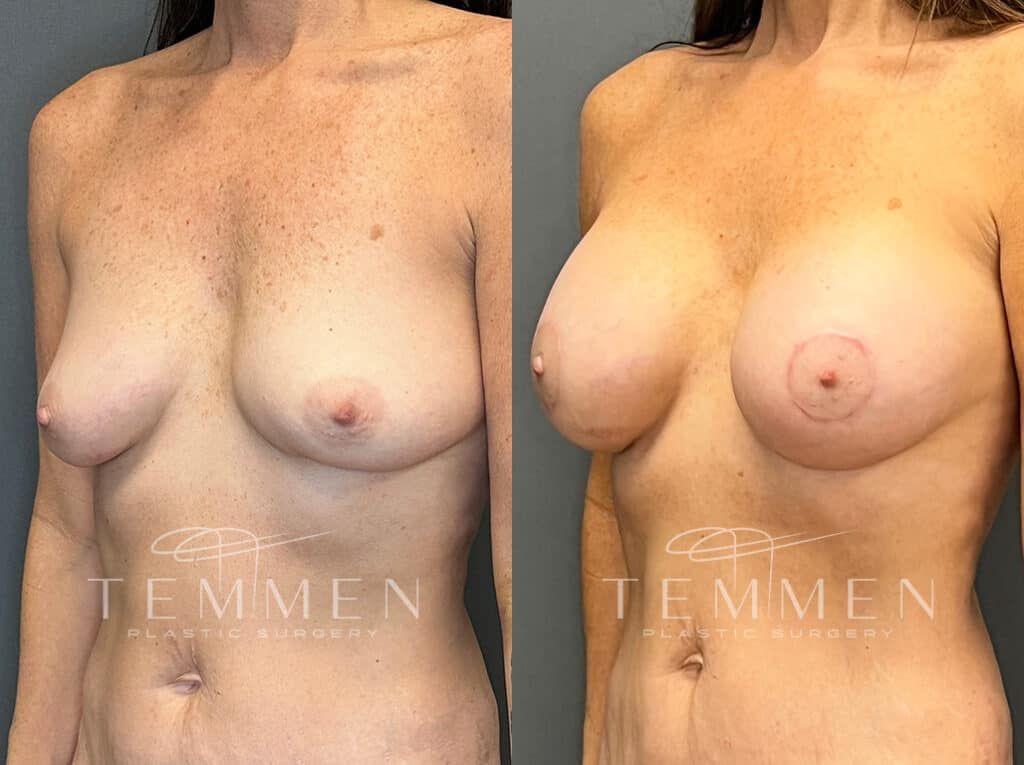 Breast Augmentation With Lift Before & After