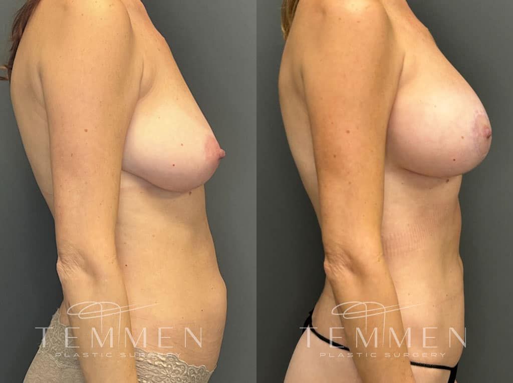 Breast Augmentation With Lift Before & After