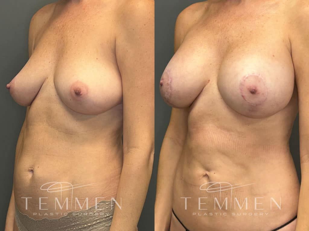 Breast Augmentation With Lift Before & After