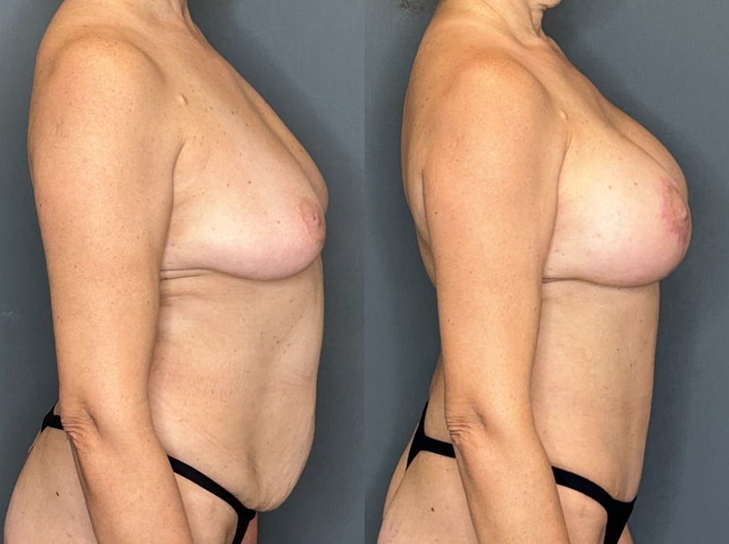 Breast Augmentation With Lift Before & After