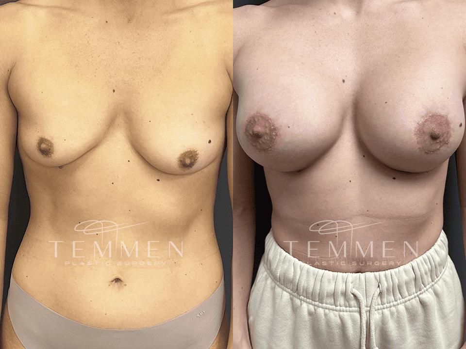 Breast Augmentation With Lift Before & After
