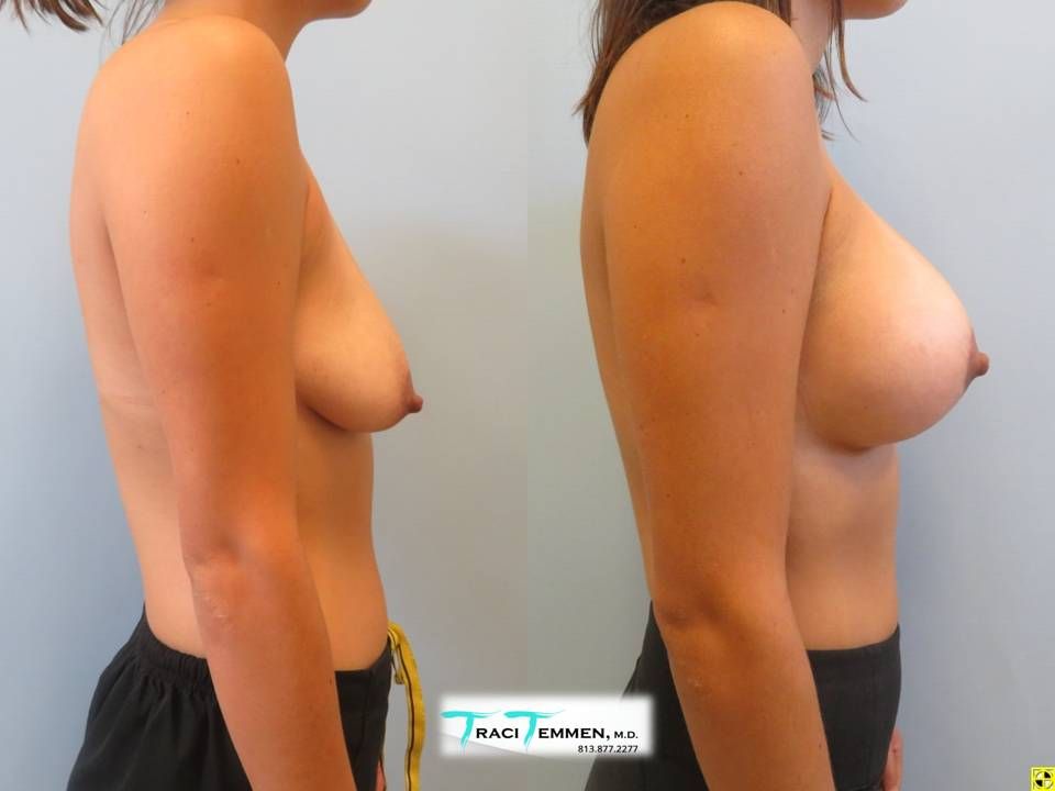 Breast Augmentation With Lift Before & After