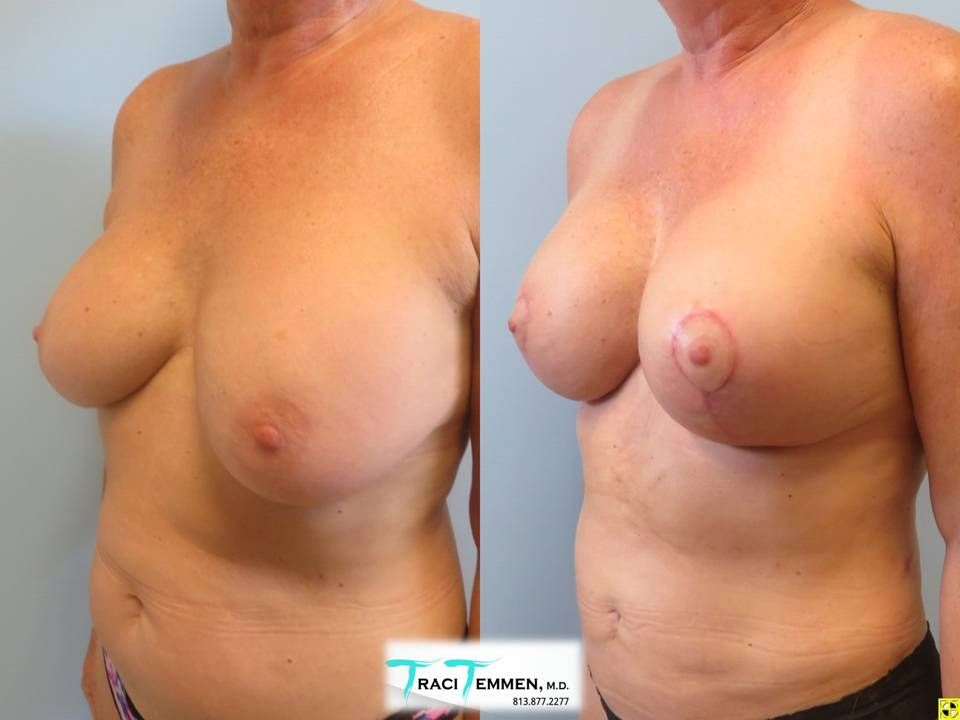 Breast Augmentation With Lift Before & After