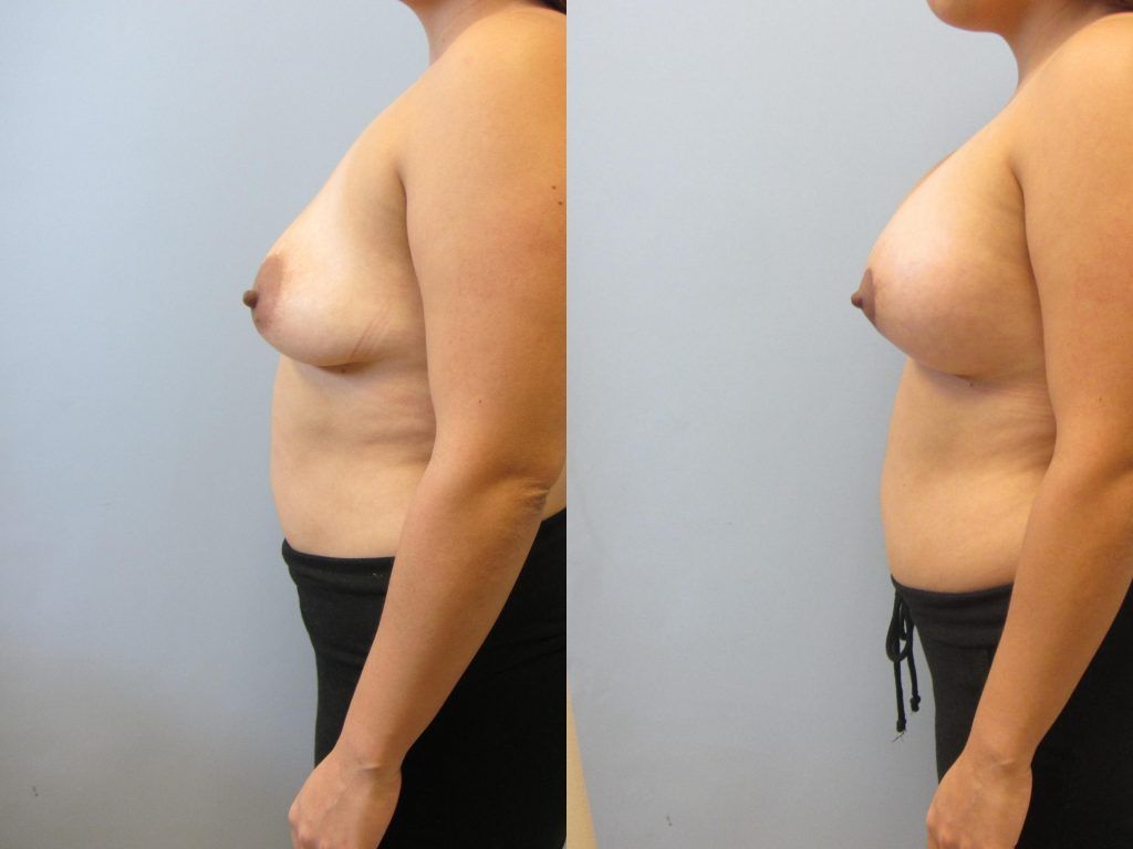 Breast Augmentation With Lift Before & After