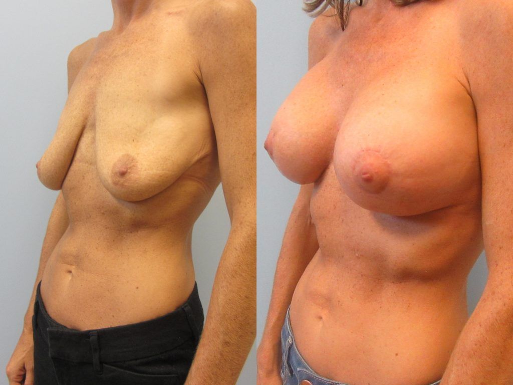 Breast Augmentation With Lift Before & After