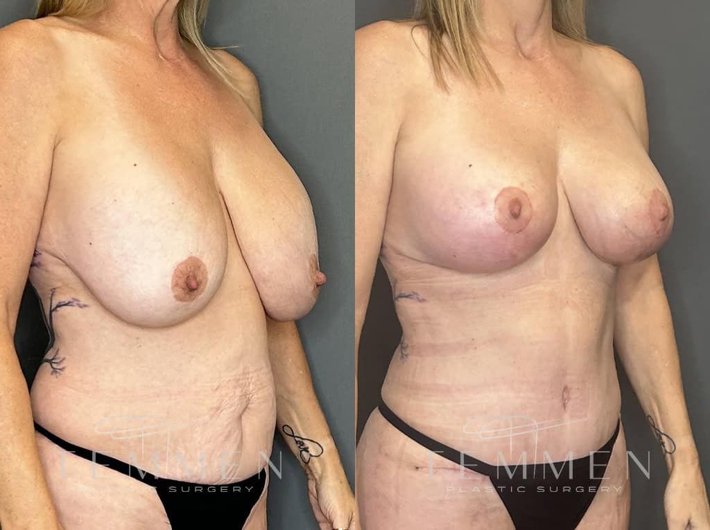 Breast Augmentation With Lift Before & After
