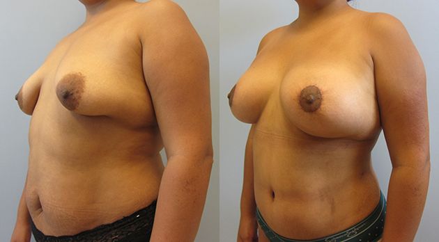 Breast Augmentation With Lift Before & After