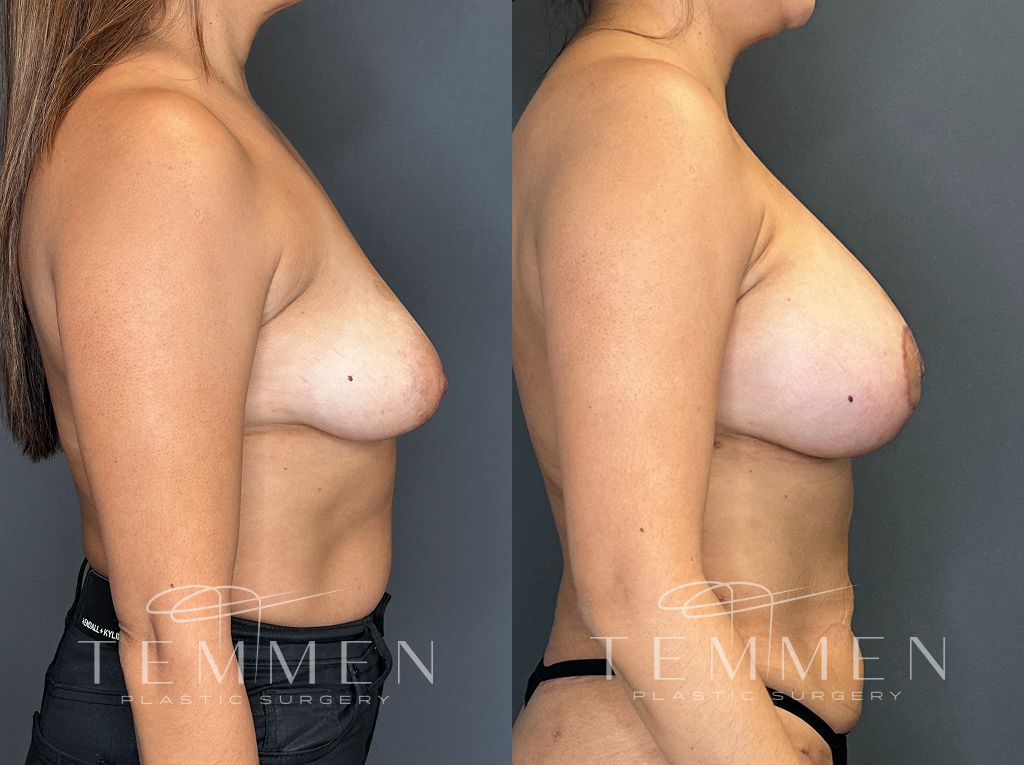 Breast Augmentation With Lift Before & After