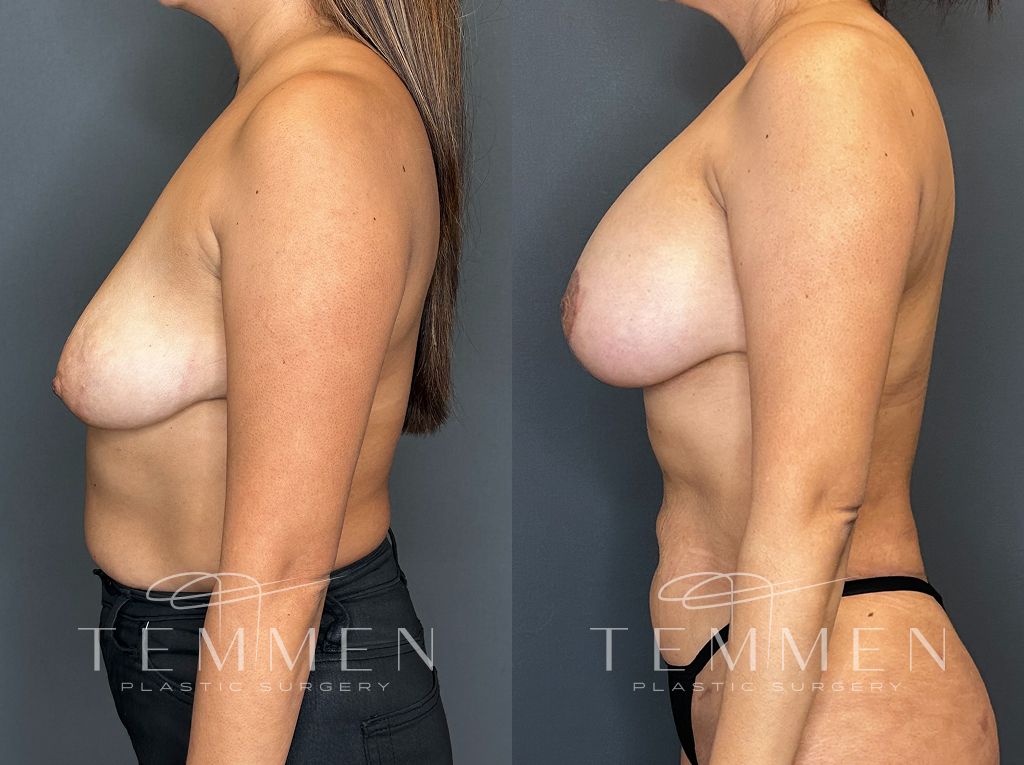 Breast Augmentation With Lift Before & After