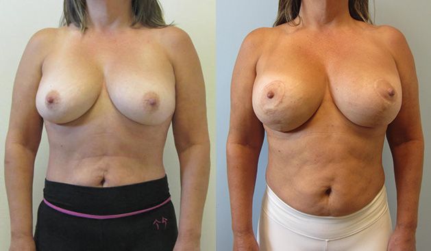 Breast Augmentation With Lift Before & After