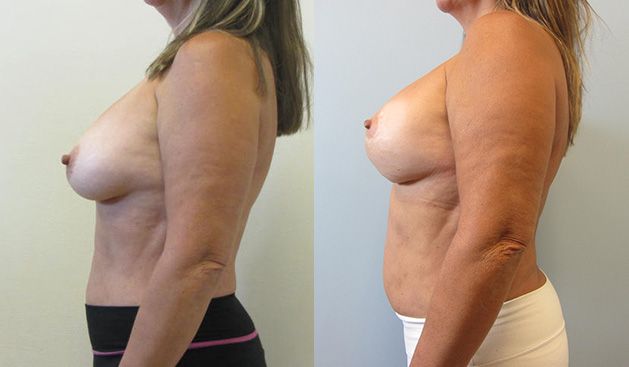 Breast Augmentation With Lift Before & After
