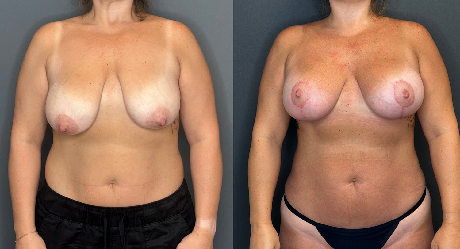 Breast Augmentation With Lift Before & After