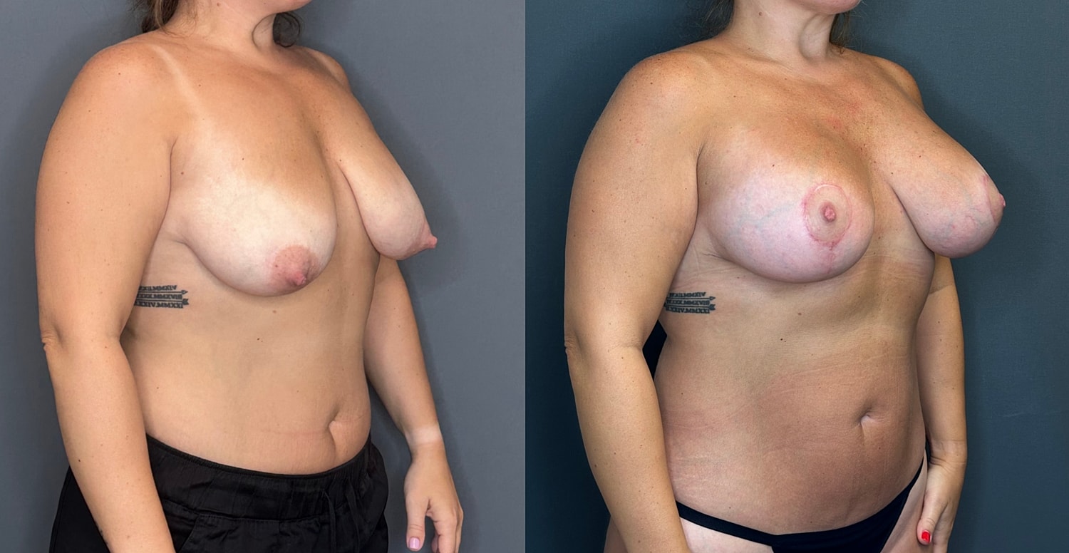 Breast Augmentation With Lift Before & After