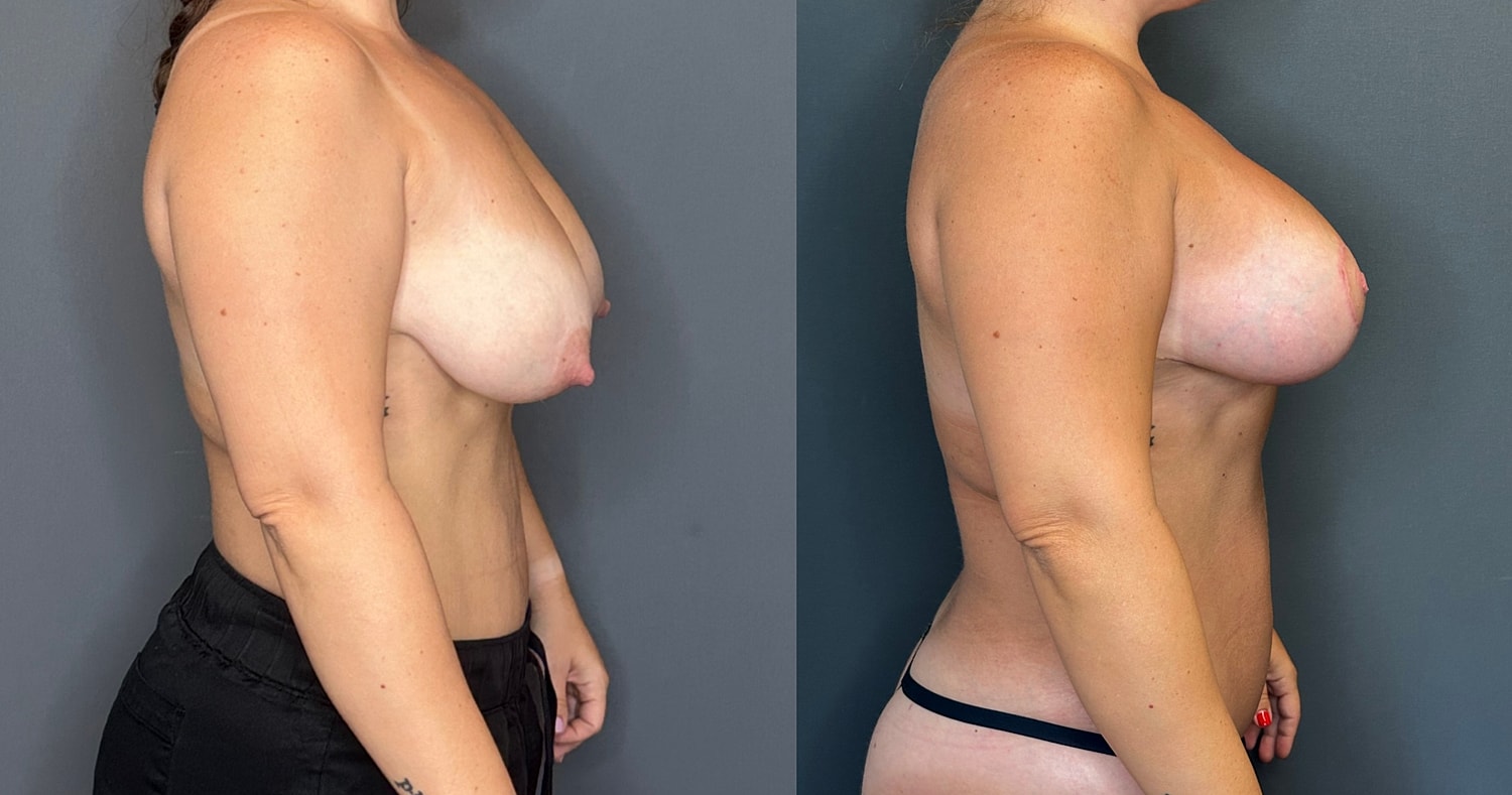 Breast Augmentation With Lift Before & After
