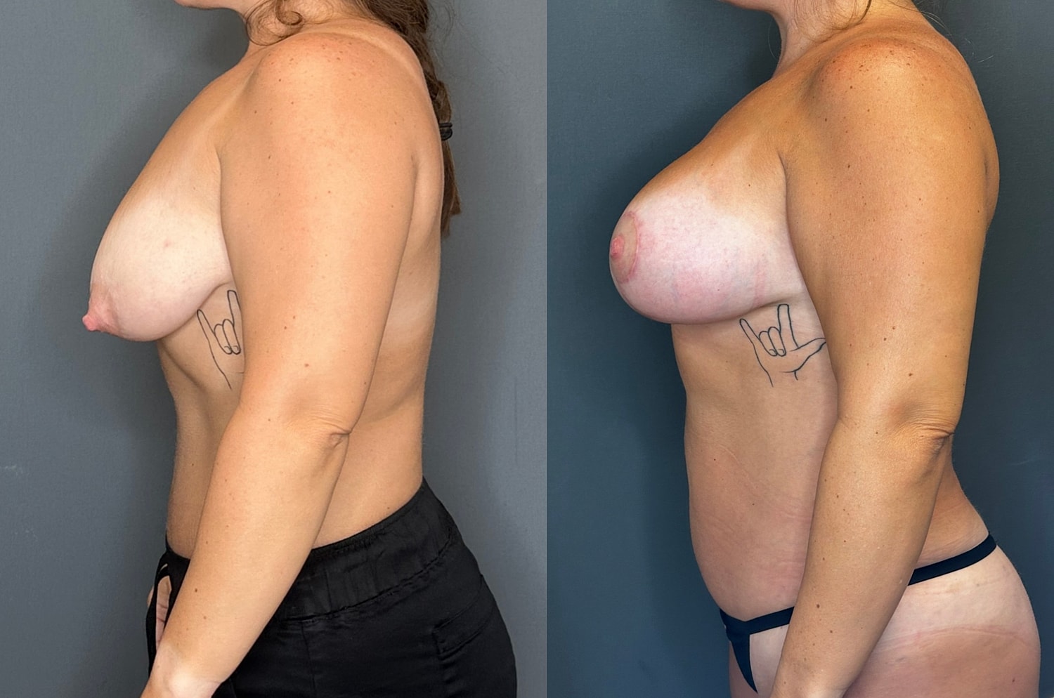Breast Augmentation With Lift Before & After
