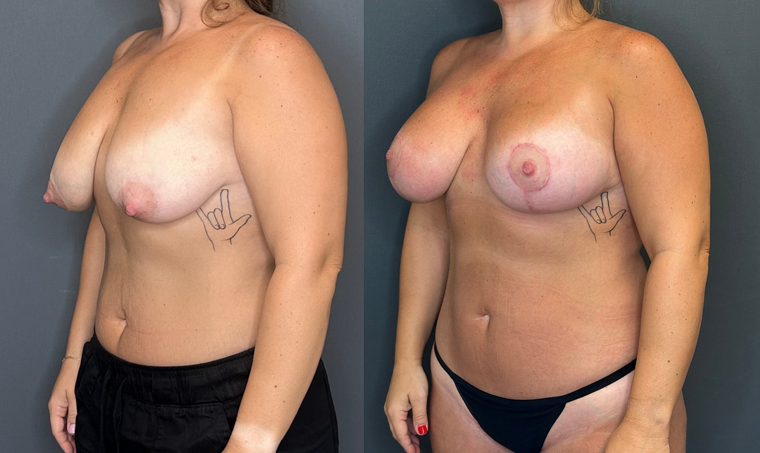 Breast Augmentation With Lift Before & After