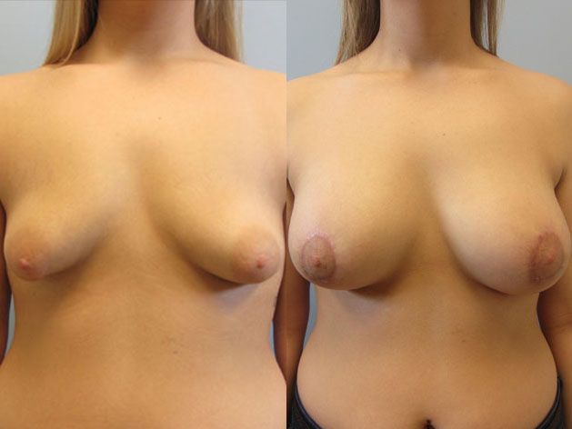 Breast Augmentation With Lift Before & After