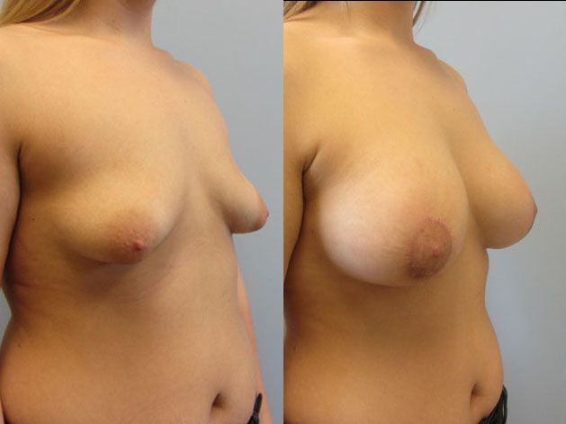 Breast Augmentation With Lift Before & After