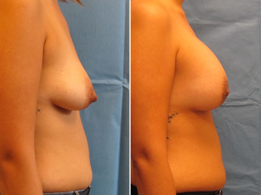 Breast Augmentation With Lift Before & After
