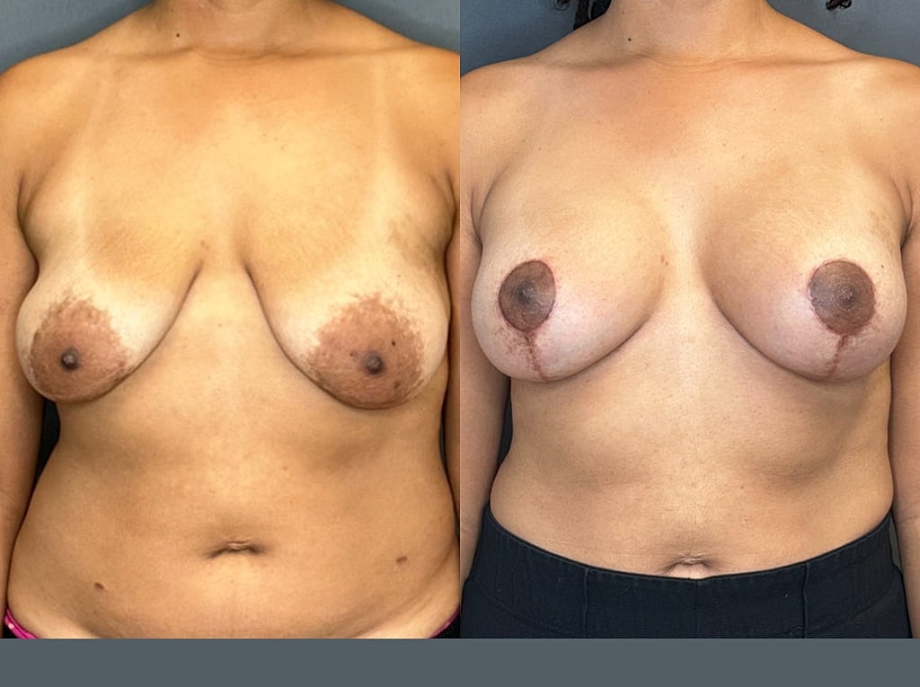 Breast Augmentation With Lift Before & After