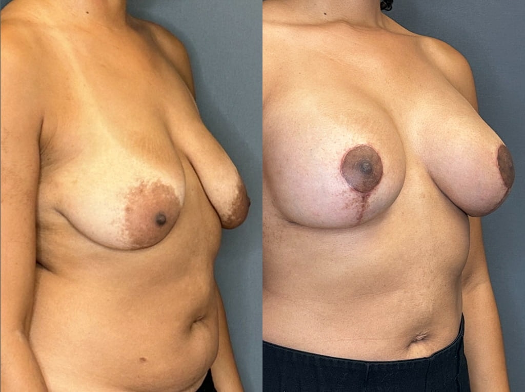 Breast Augmentation With Lift Before & After