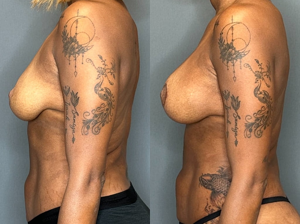 Breast Augmentation With Lift Before & After