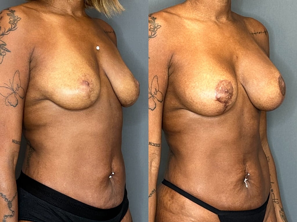 Breast Augmentation With Lift Before & After