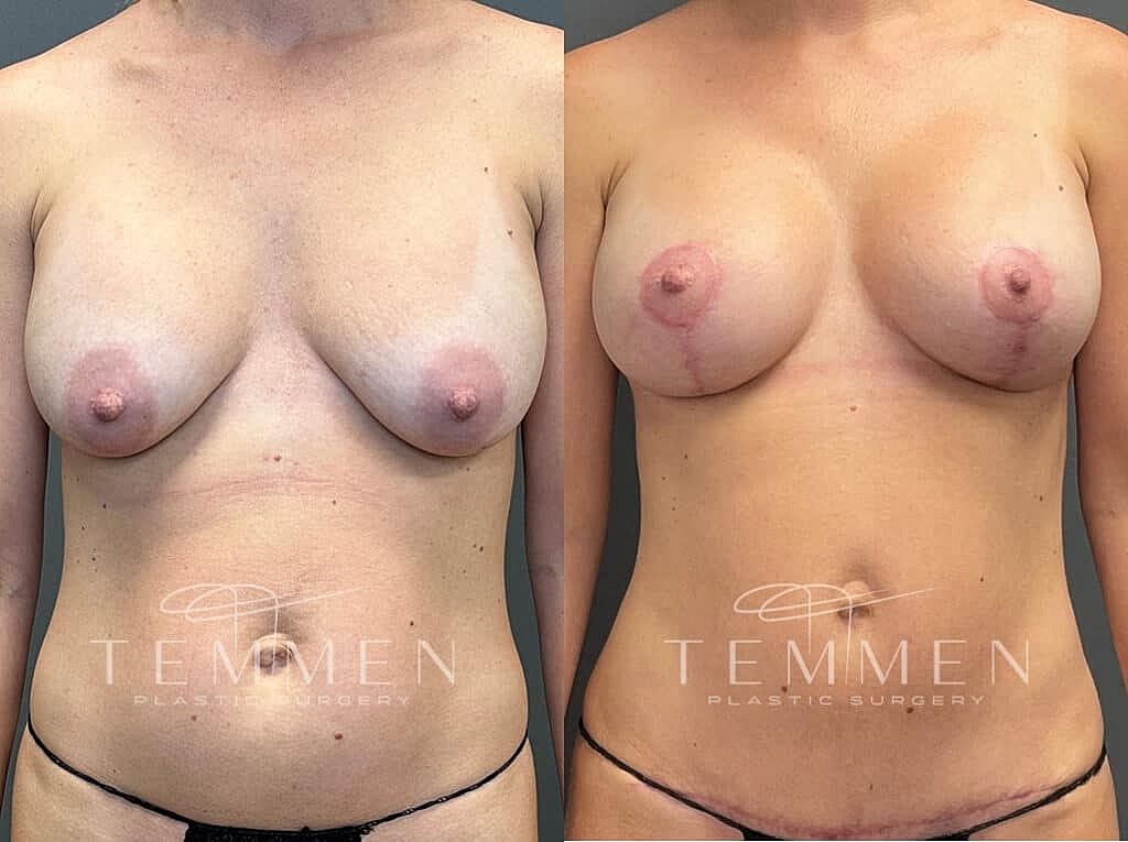 Breast Augmentation With Lift Before & After