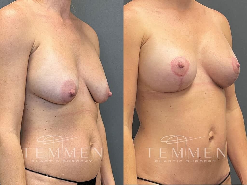 Breast Augmentation With Lift Before & After