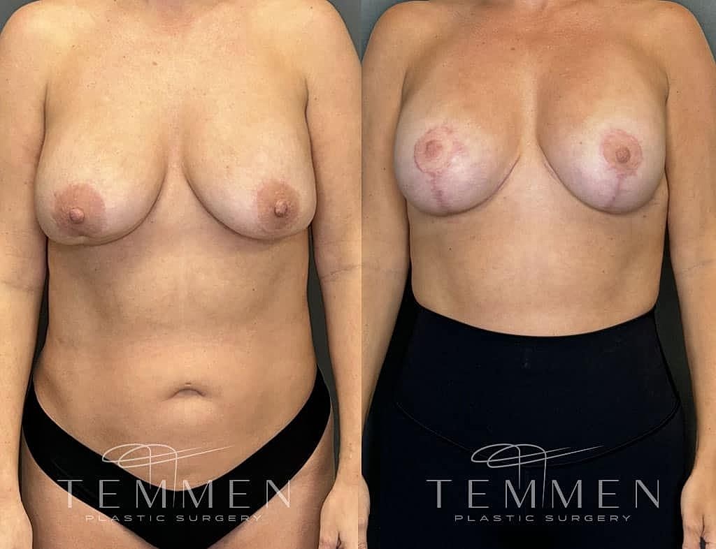 Breast Augmentation With Lift Before & After