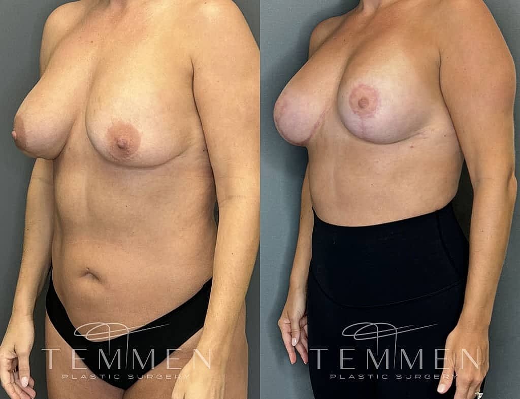 Breast Augmentation With Lift Before & After