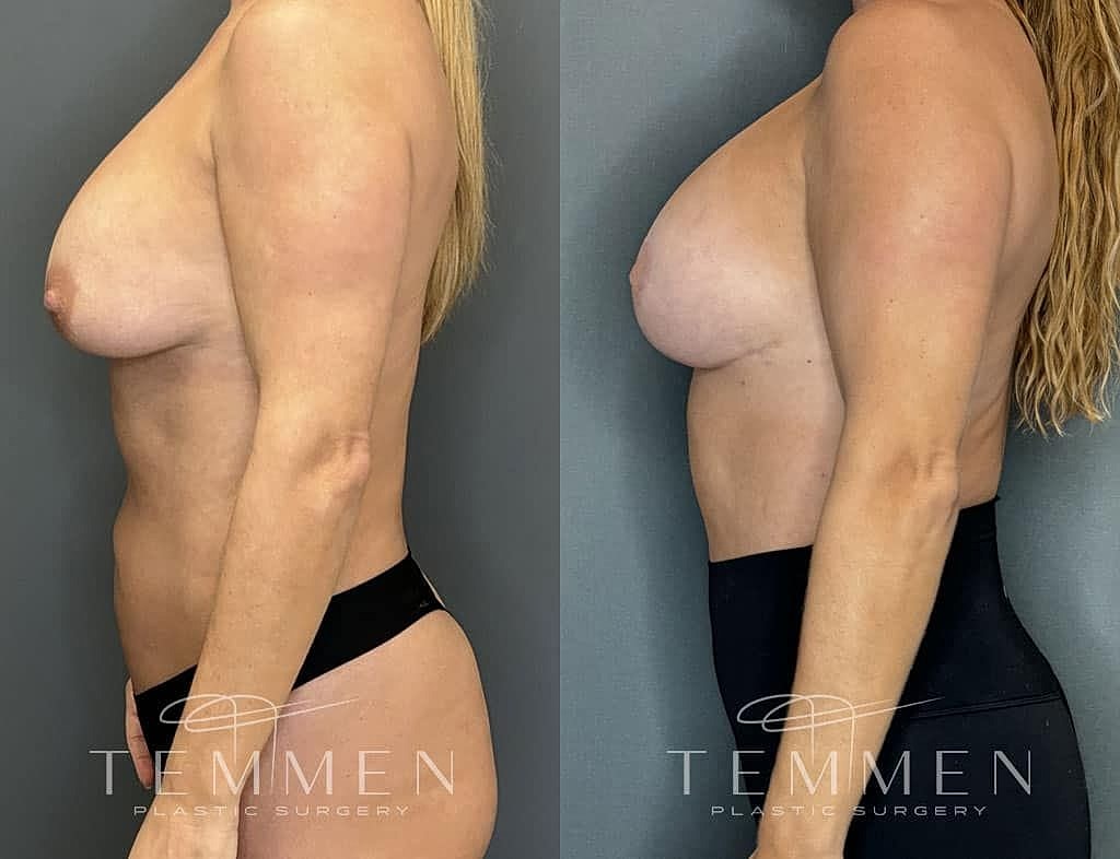 Breast Augmentation With Lift Before & After