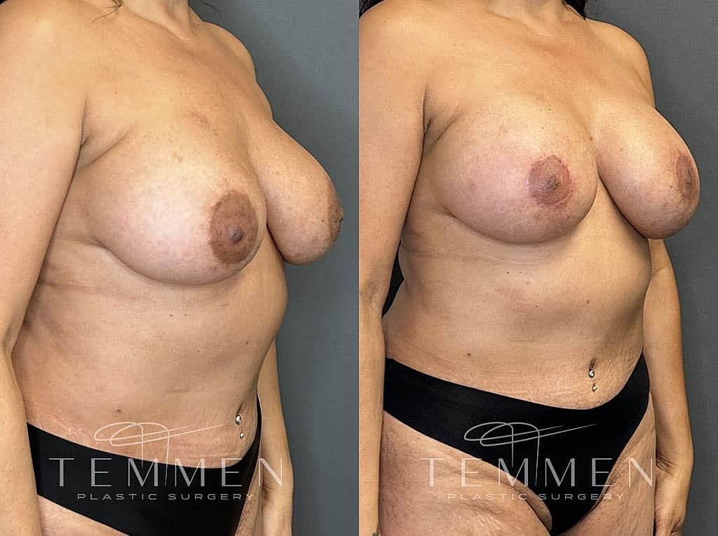 Breast Augmentation With Lift Before & After