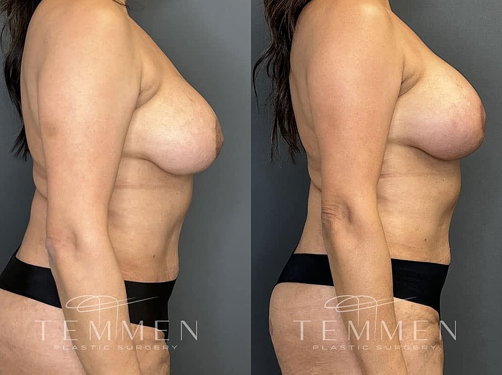 Breast Augmentation With Lift Before & After